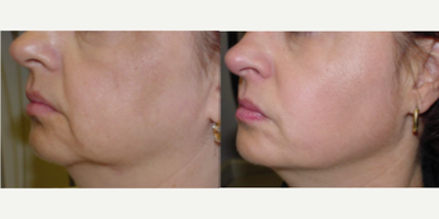 45-54 year old woman treated with ThermiSmooth Face - Patient was treated with a ThermiSmooth to the lower face & neck
