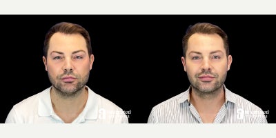 35-44 year old man treated with Hyaluronidase - The patient is a 36-year-old male who had concerns about the appearance of his midface after previous filler treatment. Dr. Chiang used 4 vials of Hylenex to dissolve filler under the eyes, the nasolabial folds, and around the mouth on the patients right side to address these concerns. The after results are 1 year post-treatment.