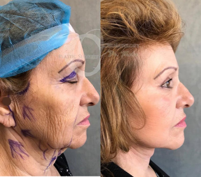 Woman treated with Chemical Peel - Woman treated with Chemical Peel (deep chemical skin treatment), shown 2 weeks post op. Patient also had laser treatment as well as Mehr design full facelift, extended neck lift, and upper eyelid surgery.