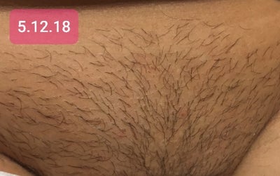 Brazilian Laser Hair Removal Ideal Image Columbus Columbus