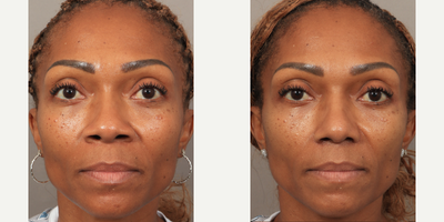 45-54 year old woman treated with Rhinoplasty, African American Rhinoplasty - 1.5 Months Post-op. Performed by Dr. Lexie Wang using the patients own rib cartilage for her rhinoplasty. Our lovely patient felt like her nose didnt fit her face, with a bulbous tip and wide nostrils. After waiting decades, she finally did something just for herself, and the results are already incredible!