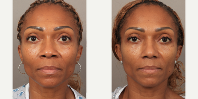 45-54 year old woman treated with Rhinoplasty, African American Rhinoplasty - 1.5 Months Post-op. Performed by Dr. Lexie Wang using the patients own rib cartilage for her rhinoplasty. Our lovely patient felt like her nose didnt fit her face, with a bulbous tip and wide nostrils. After waiting decades, she finally did something just for herself, and the results are already incredible!