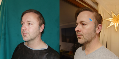 35-44 year old man treated with Cheek Implants - For lower infection risk versus an intraoral approach, implants were placed transconjunctivally and were fixated with two screws to avoid implant mobilization risk.