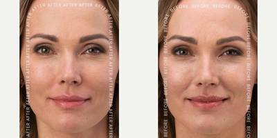 Woman treated with RHA Collection Fillers - Just two syringes of RHA 4 made all the difference in this patient's Smile Lines and Laugh Lines.