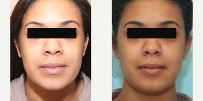 Alarplasty and Weir Excision for a Wide Nose - This is a 22 year old young woman who had concerns about the size of her nose. Specifically, she was interested in narrowing the base of her nose  where the nose meets the face  and decreasing the flare of her nostrils. She underwent an alar base excision (Weir excision) to narrow the base of the nose and decrease her alar flare. This was done in the office under local anesthesia. She did very well after surgery with minimal bruising and swelling. At 2 months after surgery, her nose has settled nicely with maintenance of her alar narrowing, well-hidden scars, and a softening of her alar flare.