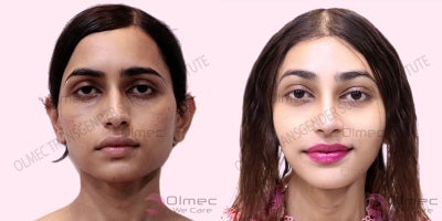 25-34 year old transgender woman treated with Facial Feminization Surgery - Forehead feminizationLowering of hair lineRhinoplastyMalar nano-fat graftingJaw line correctionV line surgery/V shapingChin feminization