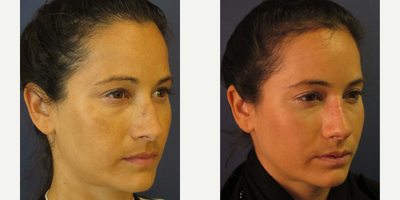 Rhinoplasty - Primary Rhinoplasty, Closed Approach