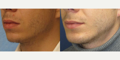 Chin Implant - Mittelman Chin Jowl Implant, submental approach
