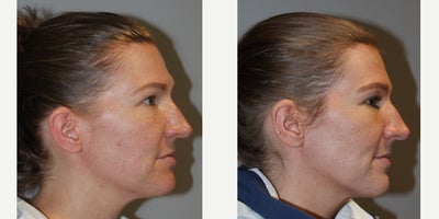 35-44 year old woman treated with Vampire Facial - Vampire Facial35 yo, F, 53, 120lbs, G1P1