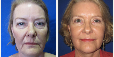 55-64 year old woman treated with Skin Tightening - Patient came in wanting to freshen up her overall look. After visiting with Dr. Ho about various options for facial rejuvenation, she elected to have a face/neck lift and fat transfer.