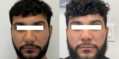 25-34 year old man treated with ProFractional Laser - ProFractional Laser