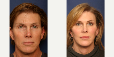 45-54 year old woman treated with MTF Facial Feminization Surgery - Facial Feminization