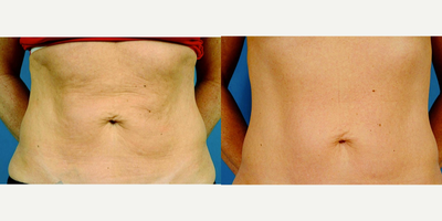 45-54 year old woman treated with Thermage - 45-54 year old woman treated with Thermage