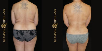 45-54 year old woman treated with Mommy Makeover, Breast Implant Revision, Breast Lift, Breast Lift with Implants, Liposuction,  - A 4554-year-old woman who underwent a comprehensive Mommy Makeover, including breast implant revision, breast lift with implants, breast lift, breast fat transfer, tummy tuck, and liposuction. The procedures addressed previous implant concerns, reshaped and enhanced the breasts, restored abdominal tone, and refined body contours. The result is a rejuvenated, balanced, and natural-looking silhouette that improves body proportion, comfort, and overall confidence.