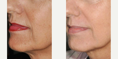 Woman treated with IPL - iplTreat sun damage, full skin, wrinkles, texture irregularities and more with IPL treatments.Intense Pulsed Light (IPL) therapy uses short blasts of high-intensity light to produce younger looking skin, with NO downtime.