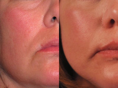 Female treated for redness and pore size - Laser genesis was used to treat redness and overall pore size.
