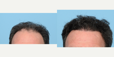 55-64 year old man treated with FUE Hair Transplant, Hair Transplant, Hair Loss Treatment, PRP for Hair Loss, NeoGraft - Age: 59Goals: Add more density and volume, fortify hairlineProcedure: FUE and PRPGrafts: 3,010Photo Timeline: 1 year post-op