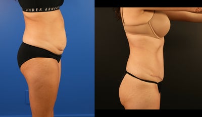 35-44 year old woman treated with Tummy Tuck, Liposuction - This 42-year-old patient sought improved abdominal contours to enhance her midsection. On examination, she presented with moderate abdominal lipodystrophy, excess abdominal skin, and rectus diastasis (separation of the abdominal muscles).Dr. Delatte performed a tummy tuck (abdominoplasty) to tighten her abdominal muscles, remove excess skin, and create a firmer, smoother profile. Additionally, 500cc of fat was removed through liposuction in the stomach area, further refining her contours and achieving a balanced silhouette.