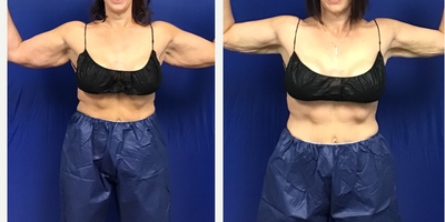 45-54 year old woman treated with Tickle Lipo - 49 year old female patient had 1125ml of fat aspirated from her arms using Tickle Lipo, followed by Renuvion Skin Tightening. After photo was taken 1 month post-op; patient will continue to see circumference reduction and skin tightening over next 2 months.