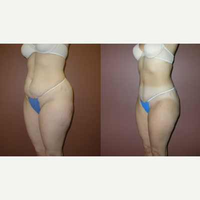 Tummy tuck with Flank Liposuction - Abdominoplasty (Tummy Tuck) with liposuction of Flanks/Sides.