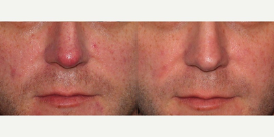 35-44 year old man treated with V Beam - Before and after V-beam treatment to reduce red broken capillaries on nose.
