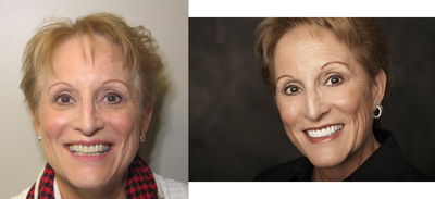 Upper Porcelain Veneers and Porcelain Crowns - 
	Patient presents with crowded, discolored teeth with dark silver fillings. Patient smile restored with porcelain veneers and porcelain crowns along with tooth whitening.
