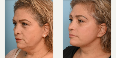 48 year old woman treated with Facelift - This 48-year-old felt wanted to create more contour and balance to her mid and lower face. Dr. Balikian performed an Extended Deep Plane Face & Neck Lift with Fat Transfer & Revision Rhinoplasty.At her 3-month post-operative visit, she looked and felt refreshed and rejuvenated.