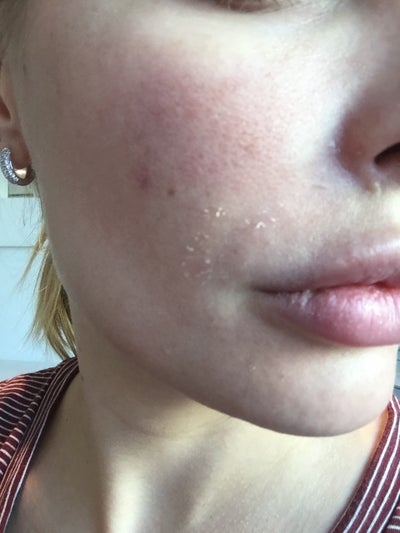 Skinmedica Rejuvenize Peel Elliot Hirsch Md Review Realself