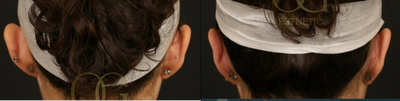 25-34 year old woman treated with Earfold - In office Otoplasty, to correct protruding ears