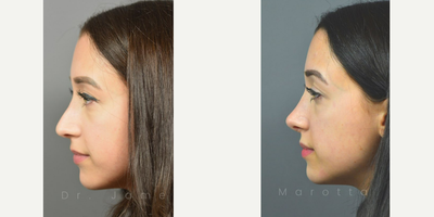 Woman treated with Revision Rhinoplasty - We checked in with this patient at her 6 month Post-Op appointment -- here's how she's doing now at 1 year.Revision Rhinoplasty is a surgery is used to repair undesirable effects from a previous nose job, most often with another physician. Not all plastic surgery procedures provide the results you desire, whether because the surgeon is inexperienced or unforeseen complications may arise. Revision rhinoplasty works to correct these undesired effects as much as possible, sometimes by grafting ear or rib cartilage if there isnt enough septal cartilage present to support the nasal structure. Revision rhinoplasty can be very complex  depending on the amount of scar tissue present and the preservation of the original nasal structure  and can last up to five hours. The risk of needing revision rhinoplasty is significantly reduced by seeing a board-certified facial plastic surgeon in the first place, so it is vital that you do your due diligence when choosing your surgeon.