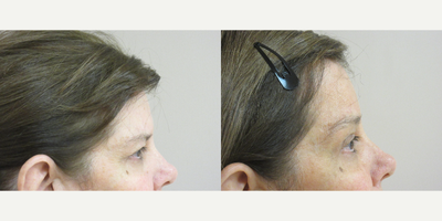 Brow Lift - Patient is 62 years old and wanted to look awake and refreshed for a special event coming up.  Dr. Eric Schaffer recommended a Browlift procedure to lift her eyelids and open up her beautiful eyes.