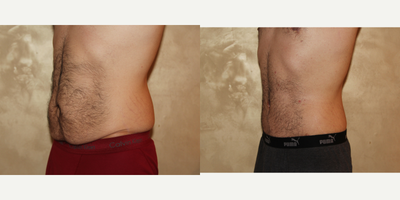 25-34 year old man treated with Male Tummy Tuck - Male Abdominoplasty