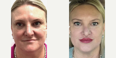 45-54 year old woman treated with Restylane Contour, Restylane Lyft, Secret RF, Dysport - Full Facial Rejuvination with RF microneedling, HA fillers and full face Dysport!