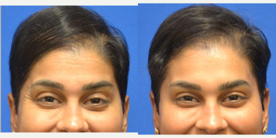 35-44 year old woman treated with Daxxify - Improved frown lines/ glabella, forehead, and crowsfeetInjected by Scarlet PA-C