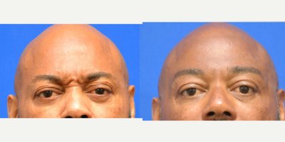 55-64 year old man treated with Daxxify - Improved forehead and frown linesInjected by Scarlet PA-C