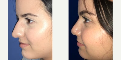 18-24 year old woman treated with Rhinoplasty - Patient is 3 months post op rhinoplasty
