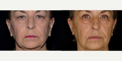 65 year old woman treated with Earlobe Repair Surgery - 65 year old woman treated with Earlobe Repair Surgery.Photos depict before and one year after surgery.