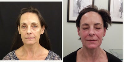 55-64 year old woman treated with ThermiSmooth - Patient has a true allergy to dermal fillers. After photo is immediately after only four ThermiSmooth Treatments.