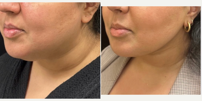 25-34 year old woman treated with FaceTite - Buccal Fat, chin and neck liposculpting, facetite