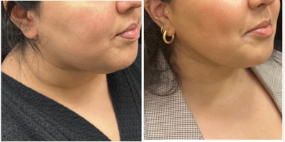 25-34 year old woman treated with FaceTite - Buccal Fat, chin and neck liposculpting, facetite