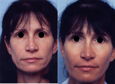 Woman treated with Cheek Implant - Woman treated with Cheek Implant