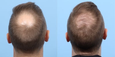 35-44 year old man treated with FUE Hair Transplant, Hair Transplant, Hair Loss Treatment, PRP Injections, PRP for Hair Loss - 3,525 grafts were transplanted to this patient's crown area to fill in a bald spot he had. Dr. Wise also performed a treatment of PRP therapy along with the FUE hair transplant to maximize results.