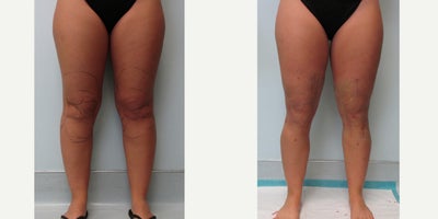 Lipo of the Knee Complex - Pt immediately following lipo of the knees, upper calf and lower thigh