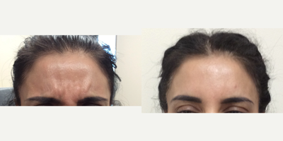 35-44 year old woman treated with Dysport Neurotoxin - Patient received Dysport Neurotoxin to the Forehead, Glabella, and Crow's Feet