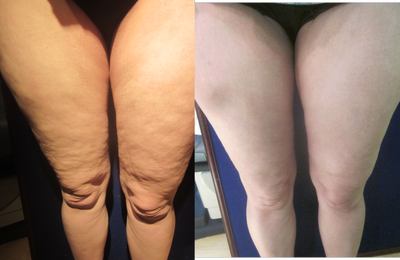 Cellulaze - 
	patient is very happy with the results of her Cellulaze treatment at the 6 week post-op visit her results will continue to improve over time
