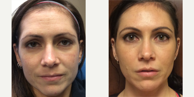 Woman treated with Bellafill - The client is a fitness trainer and had lipoatrophy (volume loss) of the face. She had lost volume above her brow, temples and cheeks. I injected Bellafill, the longest lasting filler, to provide a non-surgical facelift and restore a more youthful, healthy look.