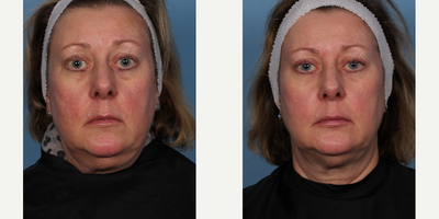 55-64 year old woman treated with CoolSculpting - CoolMini administered to reduce chin fat.
