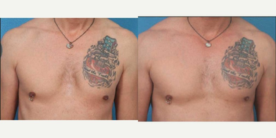 45-54 year old man treated with Fat Transfer - Patient was treated with fat transfer to correct pectus deformity