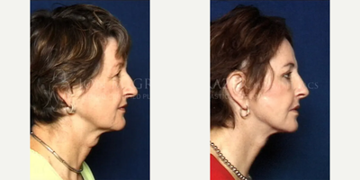 55-64 year old woman treated with Phenol Peel - 58 yo facelift, quad bleph, canthopexy, perioral phenol peel, dorsal nasal reconstruction. Pt had previous radiation therapy for skin cancer with resorption of the cartilagecorrection of neck thyroidectomy scar.