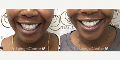 45-54 year old woman treated with Dimple Surgery - Dimples surgery (Dimpleplasty)